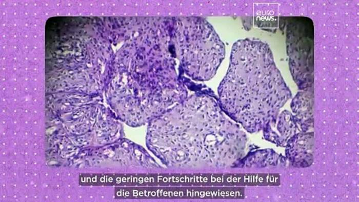 News video: Mangelnde Forschung für PCOS: 70 Prozent der Frauen weltweit nicht diagnostiziert